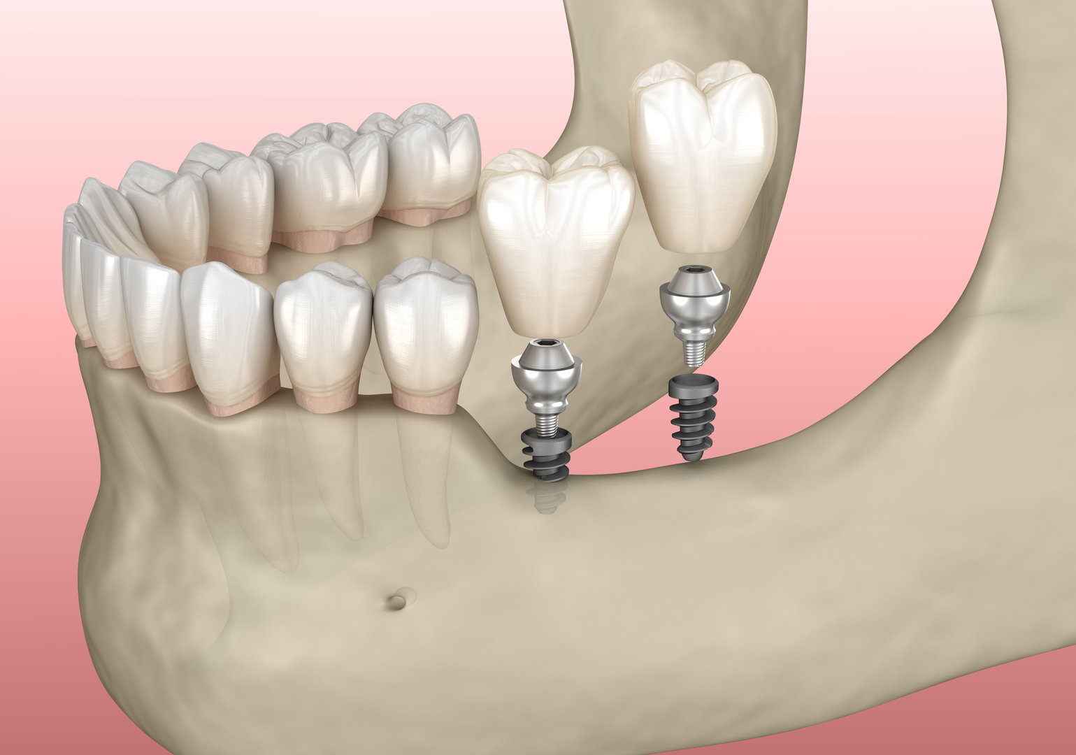 top-implant-dentist3
