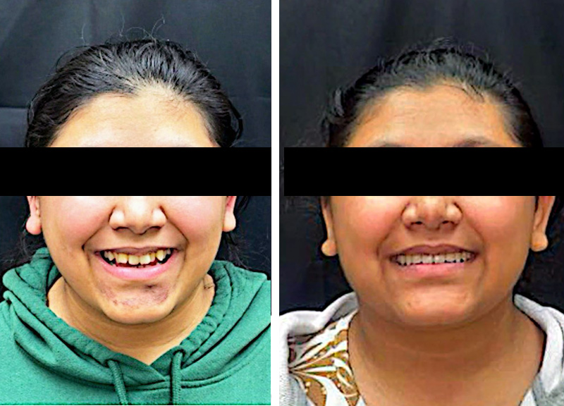 Invisalign in Waterbury